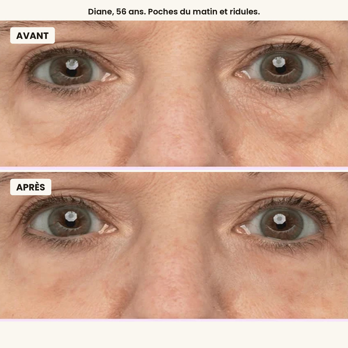 Avant / après, Diane, 56 ans, poches du matin et ridules