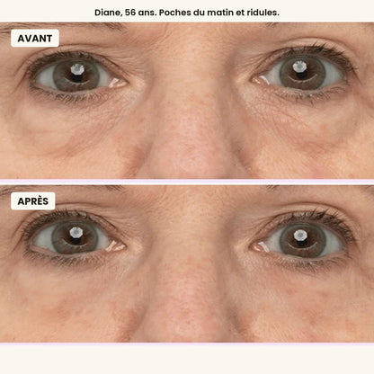 Avant / après, Diane, 56 ans, poches du matin et ridules